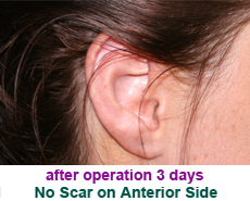 plastic-surgery-prominent-ear 